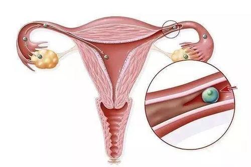 宫外孕是怎么引起的，宫外孕的原因