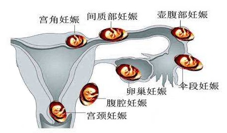 腹腔宫外孕