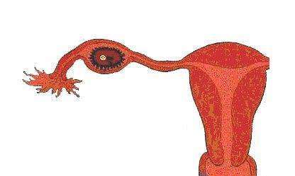 输卵管宫外孕症状
